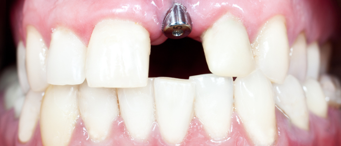 why-replacing-a-missing-tooth-is-good-for-your-oral-health
