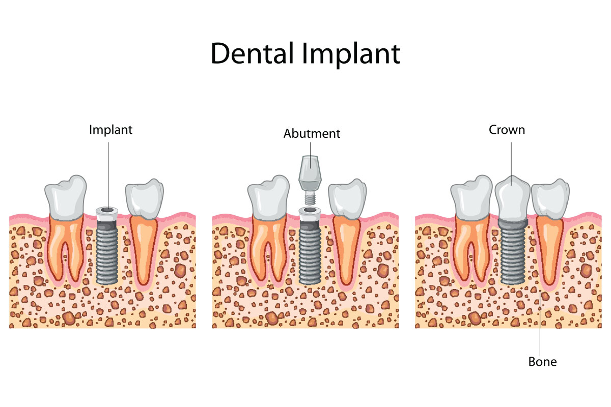 dental-implants-city-smiles-dentist-melbourne-cbd